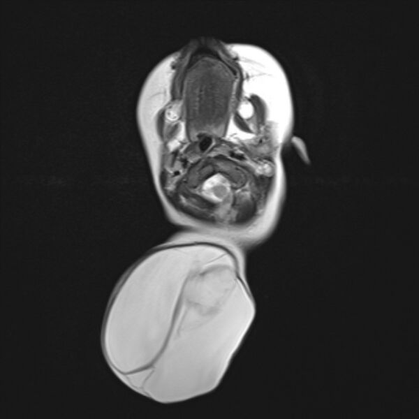 File:Chiari III malformation with occipital encephalocele (Radiopaedia 79446-92559 Axial T2 8).jpg