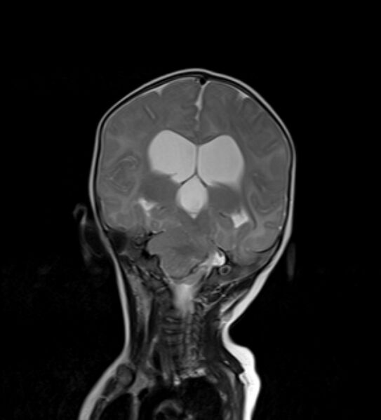 File:Chiari III malformation with occipital encephalocele (Radiopaedia 79446-92559 Coronal T2 20).jpg
