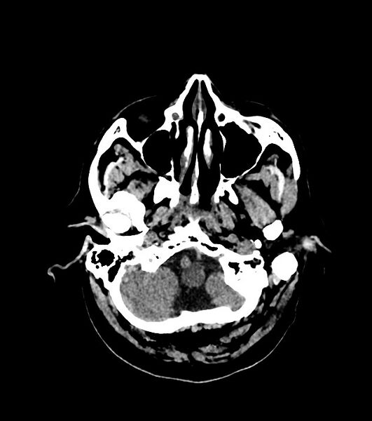 File:Cholangiocarcinoma with cerebral metastases (Radiopaedia 83519-98628 Axial non-contrast 14).jpg