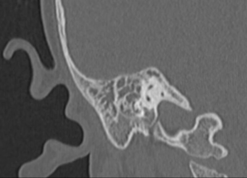 File:Cholesteatoma (Radiopaedia 73023-83750 Coronal Right ear 61).jpg