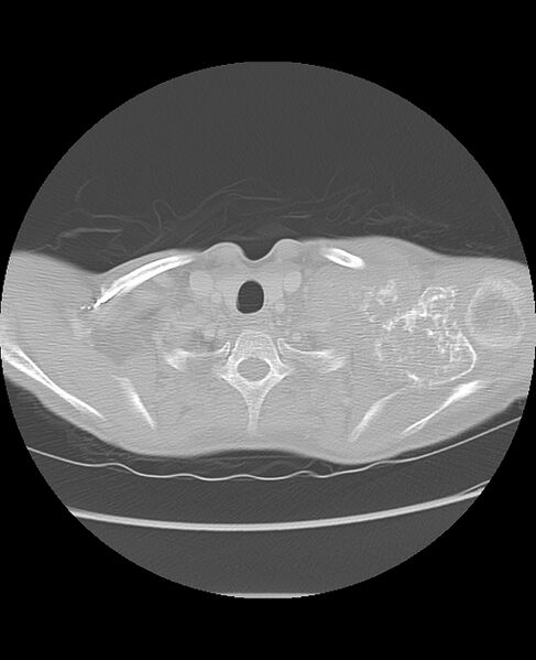 File:Chondrosarcoma (Radiopaedia 79427-92532 Axial lung window 4).jpg