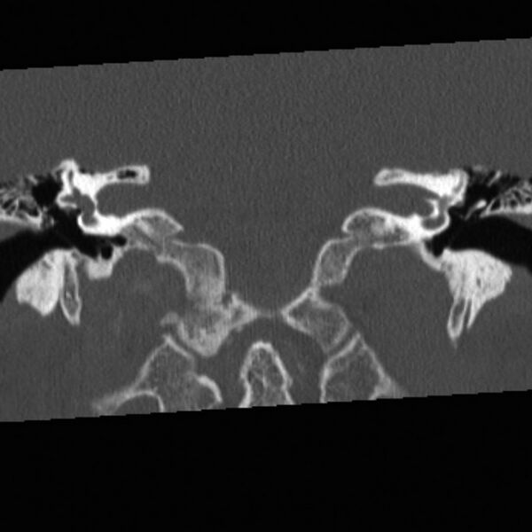 File:Chondrosarcoma - occipital condyle (Radiopaedia 8969-9745 Coronal bone window 1).jpg