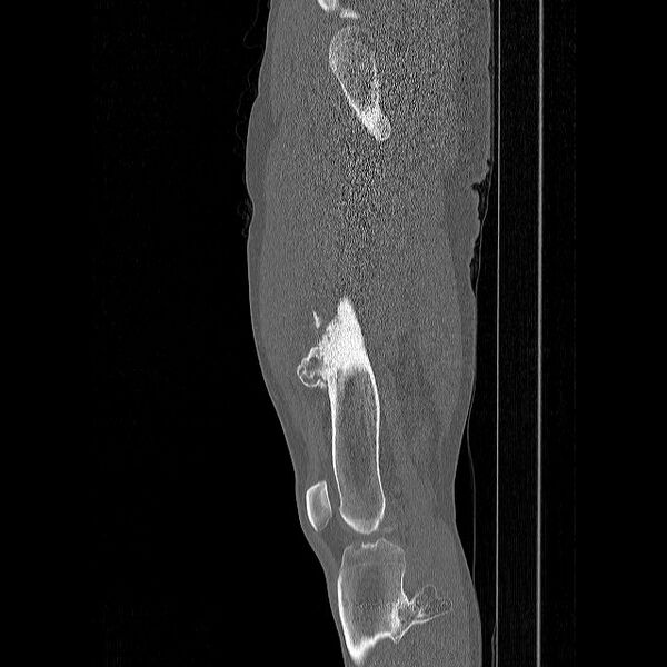 File:Chondrosarcoma arising from exostosis (Radiopaedia 59996-67507 Sagittal bone window 5).jpg