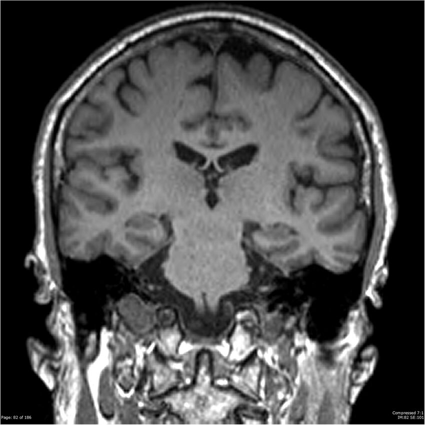 Chondrosarcoma of skull base- grade II (Radiopaedia 40948-43654 Coronal T1 3).jpg