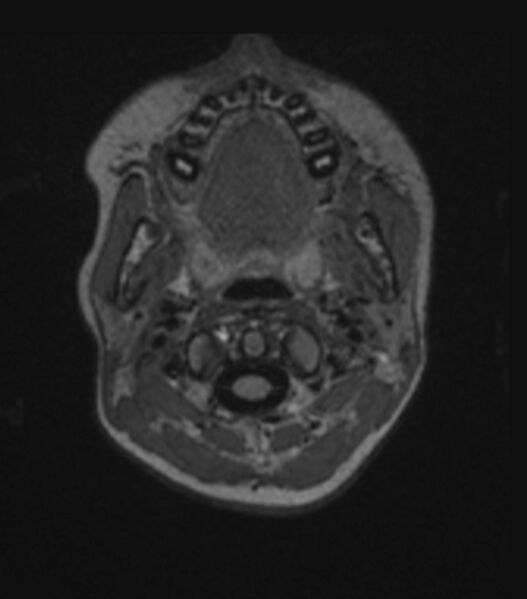 File:Choroid plexus carcinoma (Radiopaedia 91013-108553 Axial FLAIR C+ 53).jpg