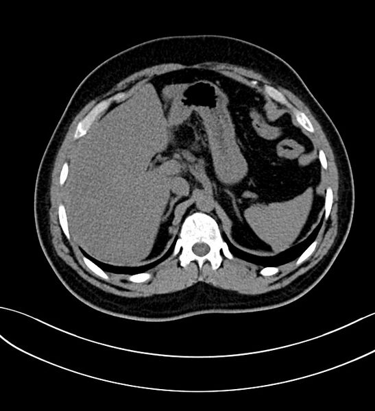 File:Chromophobe renal cell carcinoma (Radiopaedia 84286-99573 Axial non-contrast 8).jpg