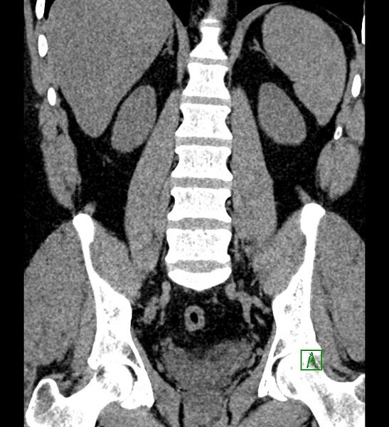 File:Chromophobe renal cell carcinoma (Radiopaedia 84286-99573 Coronal non-contrast 119).jpg