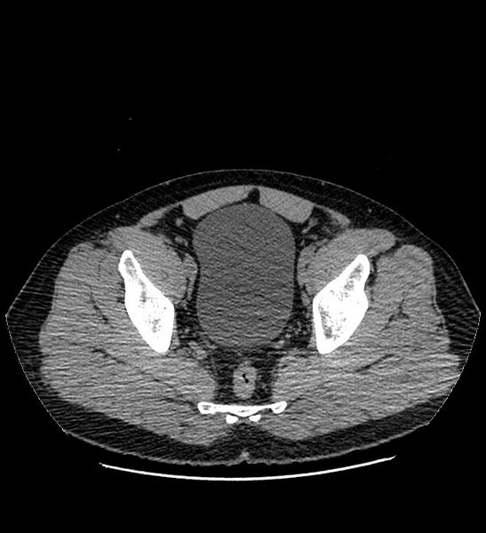 File:Chromophobe renal cell carcinoma (Radiopaedia 84337-99693 Axial non-contrast 141).jpg