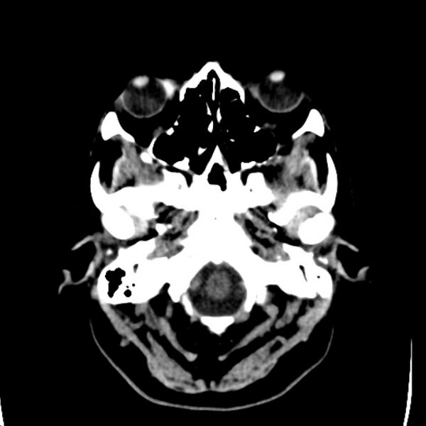 File:Chronic bilateral occipital lobe infarcts (Radiopaedia 31276-31996 Axial non-contrast 4).jpg