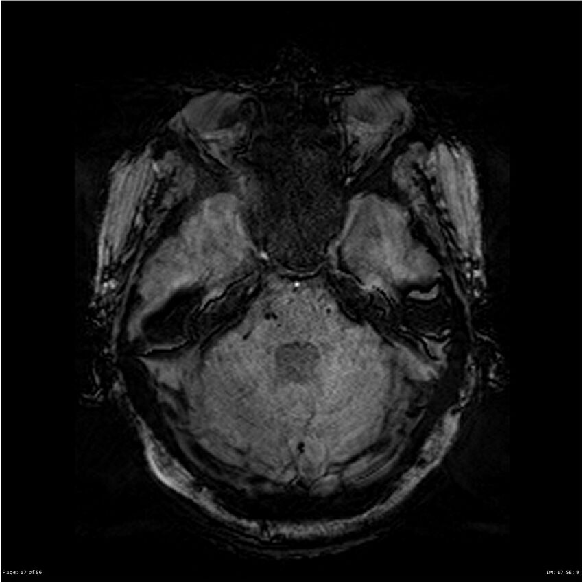 Chronic hypertensive encephalopathy (Radiopaedia 25764-25918 Axial SWI 17).jpg