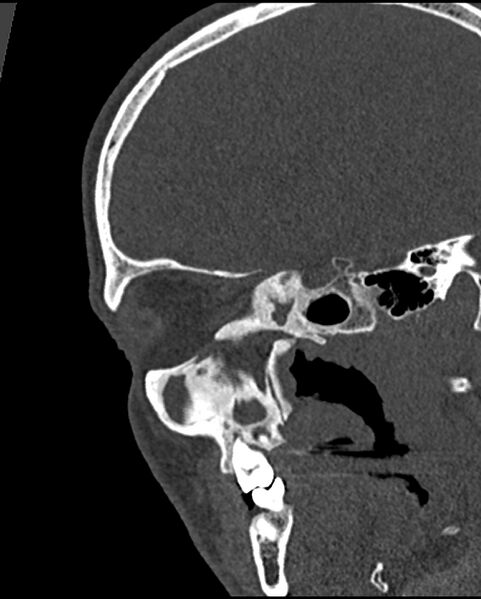 File:Chronic maxillary sinusitis caused by a foreign body (Radiopaedia 58521-65676 Sagittal bone window 45).jpg