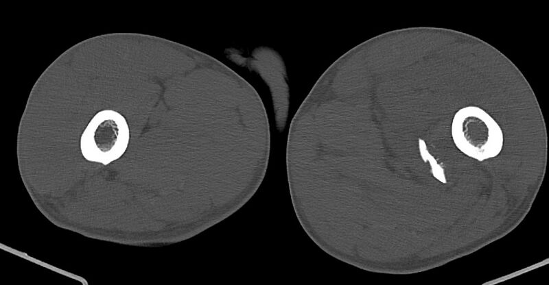 File:Chronic osteomyelitis (with sequestrum) (Radiopaedia 74813-85822 Axial non-contrast 75).jpg