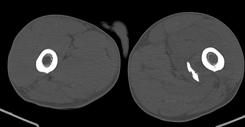 Chronic osteomyelitis (with sequestrum) (Radiopaedia 74813-85822 Axial non-contrast 75).jpg