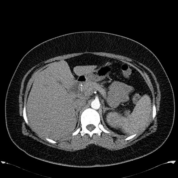 File:Chronic thromboembolic pulmonary hypertension (CTEPH) (Radiopaedia 74597-85531 Axial C+ CTPA 59).jpg