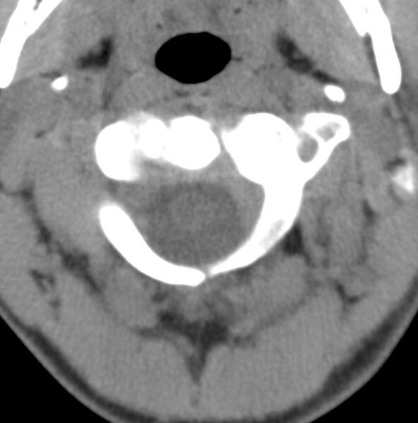 File:Cleft of the posterior arch of C1 mimicking fracture (Radiopaedia 40201-42721 Axial non-contrast 1).jpg
