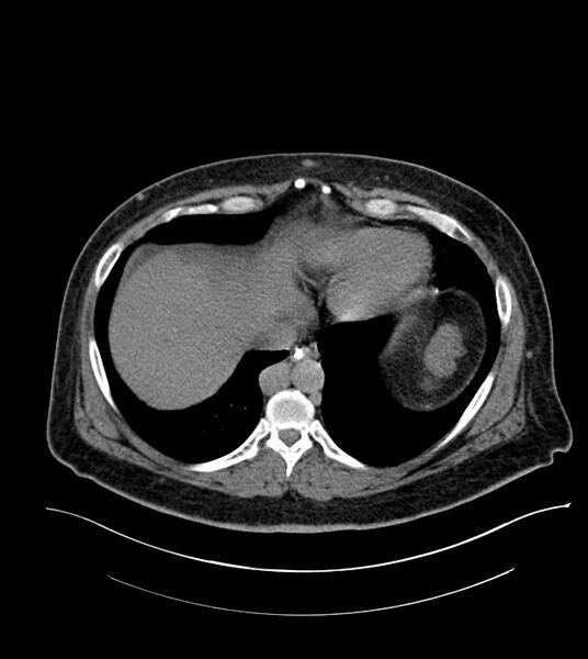 File:Closed-loop small bowel obstruction-internal hernia (Radiopaedia 78439-91096 Axial non-contrast 18).jpg