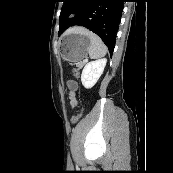 File:Co-existing acute appendicitis and epiploic appendagitis (Radiopaedia 61789-69911 B 75).jpg