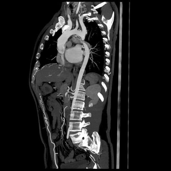 File:Coarctation of aorta (Radiopaedia 25384-25630 C+ arterial phase 3).jpg