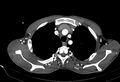 Coarctation of aorta with aortic valve stenosis (Radiopaedia 70463-80574 A 17).jpg