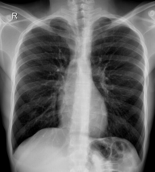 File:Coarctation of the aorta (Radiopaedia 12461-12696 Frontal 1).jpg