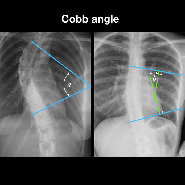 File:Cobb angle measurment (Radiopaedia 49374).png