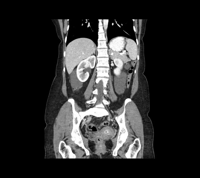 File:Cocoon abdomen with possible tubo-ovarian abscess (Radiopaedia 46235-50636 B 35).jpg