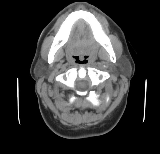 File:Colloid cyst of thyroid (Radiopaedia 22897-22923 Axial non-contrast 15).jpg