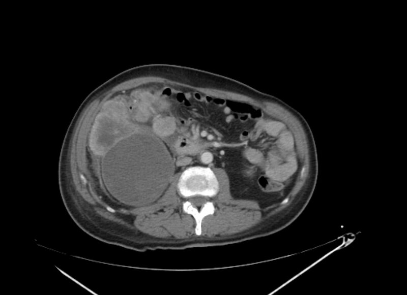 File:Colon cancer mimicking renal cell carcinoma (Radiopaedia 28986-29335 C 37).jpg