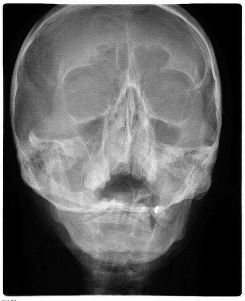 File:Frontal and maxillary sinusitis (Radiopaedia 46427).png