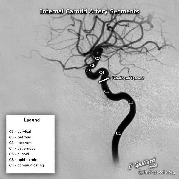 File:Internal carotid artery segments (illustration) (Radiopaedia 36107).jpg