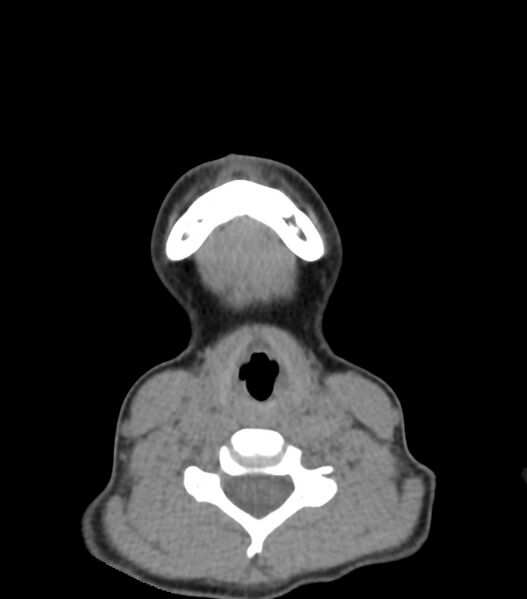File:Nasoorbitoethmoid fracture (Radiopaedia 90044-107205 Axial non-contrast 30).jpg