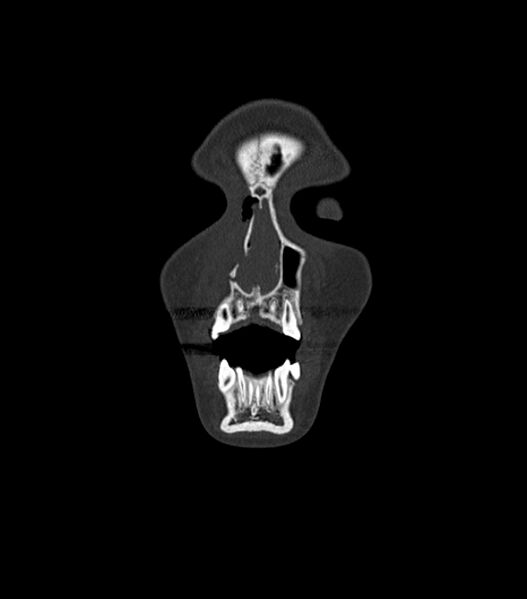File:Nasoorbitoethmoid fracture (Radiopaedia 90044-107205 Coronal bone window 27).jpg