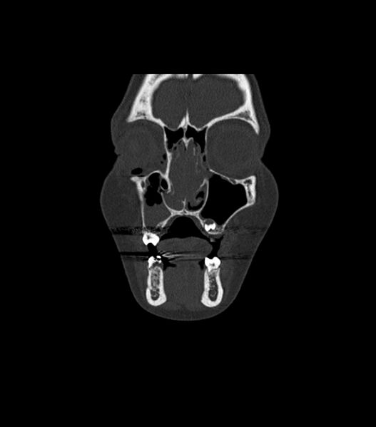 File:Nasoorbitoethmoid fracture (Radiopaedia 90044-107205 Coronal bone window 36).jpg