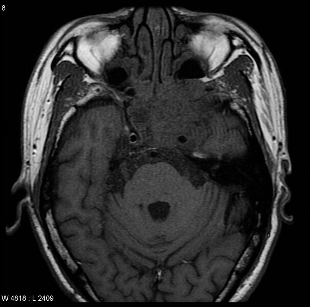 File:Nasopharyngeal carcinoma (Radiopaedia 4546-6667 Axial T1 3).jpg