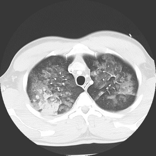 File:Near drowning pulmonary edema (Radiopaedia 16868-16591 Axial lung window 7).jpg