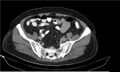 Necrotizing pancreatitis (Radiopaedia 20595-20495 Axial C+ delayed 36).jpg