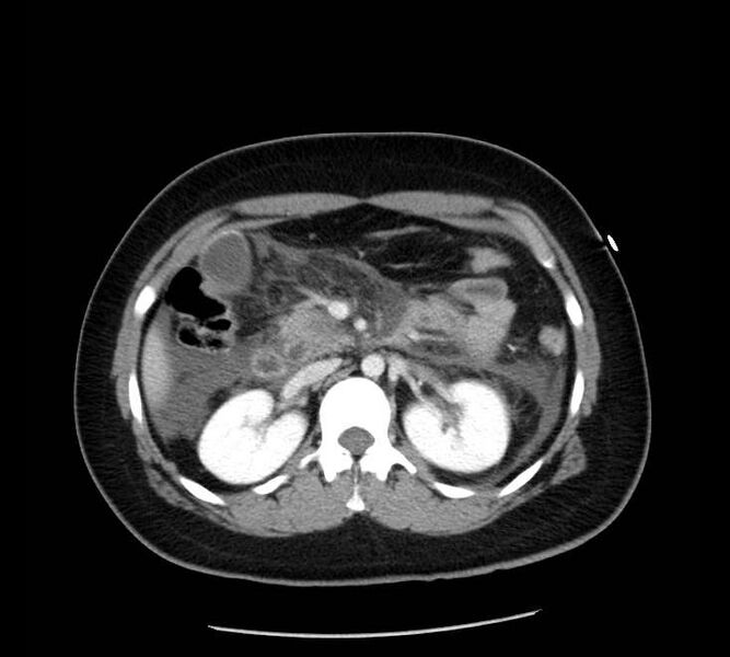 File:Necrotizing pancreatitis (Radiopaedia 23001-23031 A 32).jpg