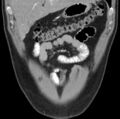 Necrotizing pancreatitis with acute necrotic collection (Radiopaedia 14470-14417 C 3).jpg