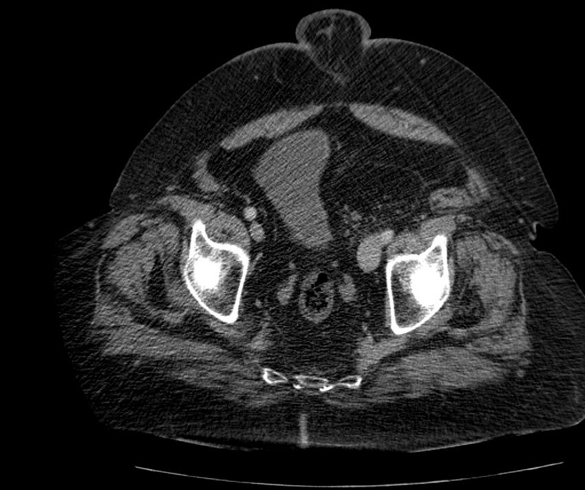 Nephroptosis with inguinal hernia containing perirenal fat (Radiopaedia 56632-63391 C 298).jpg