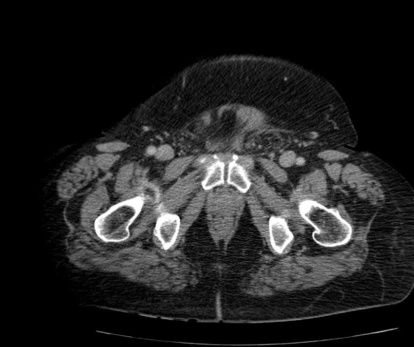 Nephroptosis with inguinal hernia containing perirenal fat (Radiopaedia 56632-63391 C 332).jpg