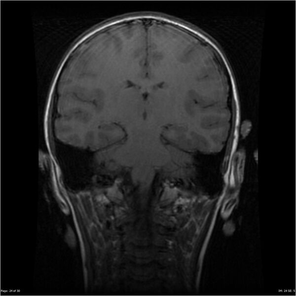 File:Neurofibromatosis type 1 (Radiopaedia 22541-22564 Coronal T1 33).jpg
