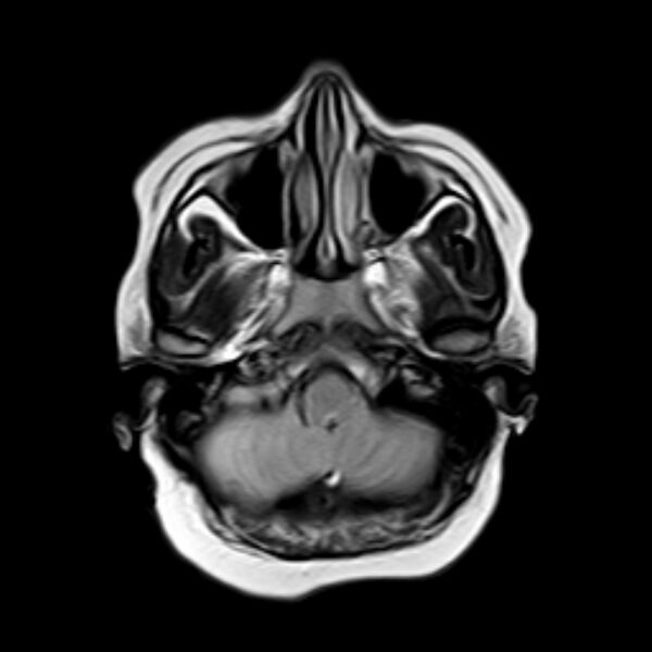 File:Neurofibromatosis type 2 (Radiopaedia 67470-76871 Axial FLAIR 3).jpg