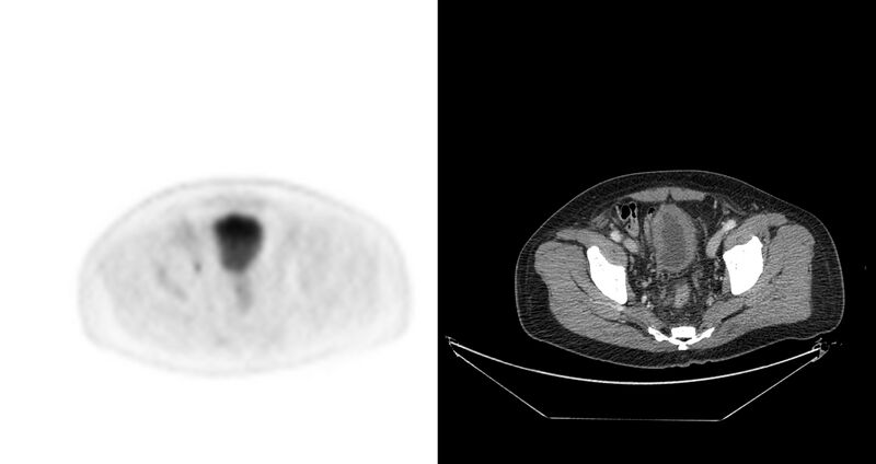 File:Non-Hodgkin lymphoma involving seminal vesicles with development of interstitial pneumonitis during Rituximab therapy (Radiopaedia 32703-33675 axial PET CT 11).jpg