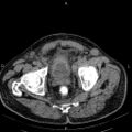 Non Hodgkin lymphoma in a patient with ankylosing spondylitis (Radiopaedia 84323-99621 Axial non-contrast 58).jpg