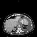 Non Hodgkin lymphoma in a patient with ankylosing spondylitis (Radiopaedia 84323-99621 B 29).jpg