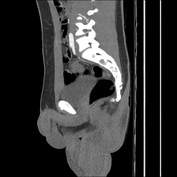 File:Normal CT angiogram of pelvis (Radiopaedia 45390-49430 C 39).jpg