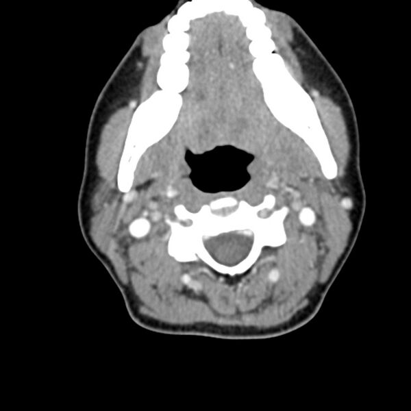 File:Normal CT of the neck (Radiopaedia 14575-14500 Axial C+ 30).jpg