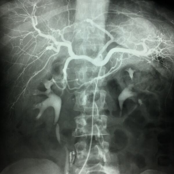 File:Normal celiac trunk (angiogram) (Radiopaedia 54996).jpg