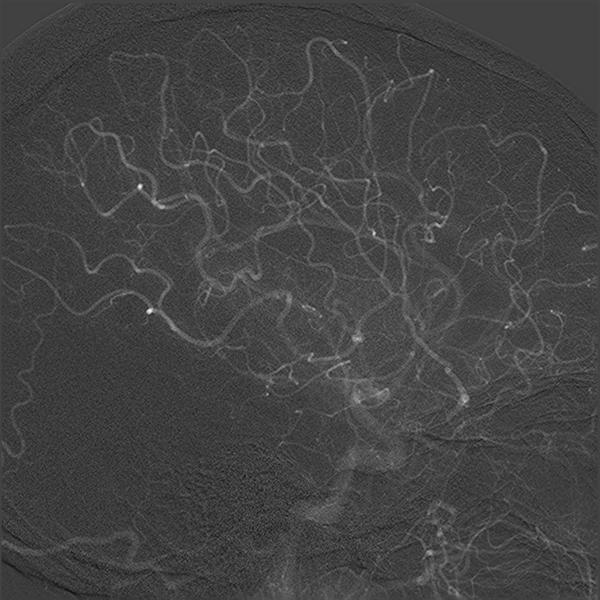 File:Normal cerebral angiogram (four vessel DSA) (Radiopaedia 41708-44649 F 11).png