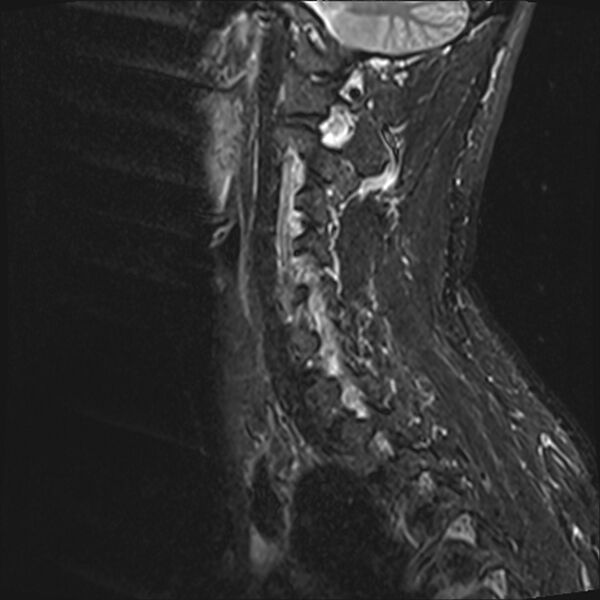 File:Normal cervical spine MRI (Radiopaedia 38418-40496 Sagittal STIR 11).jpg